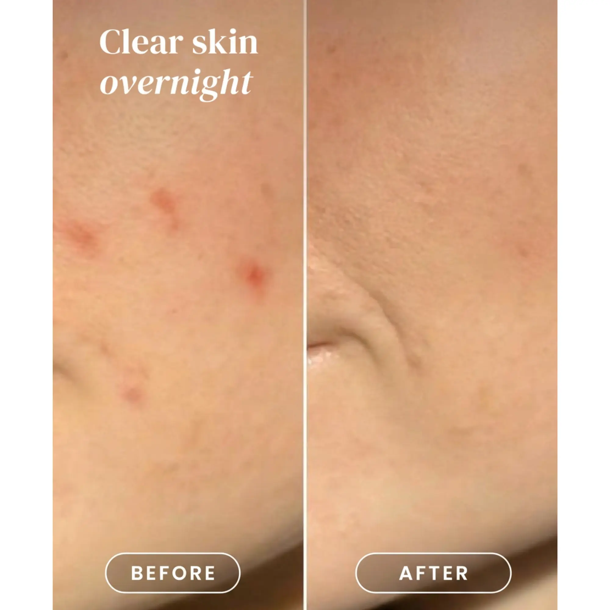 Pimple Patches - Image 7