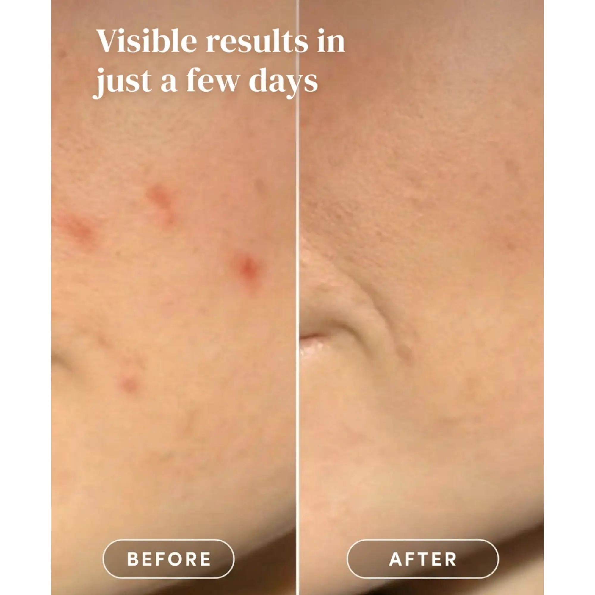 Post Pimple Patches - Image 7