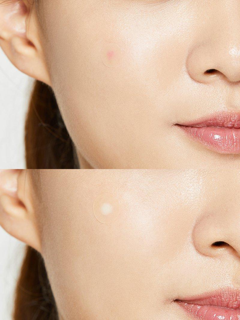 Acne Pimple Master Patch Original Fit - Image 2
